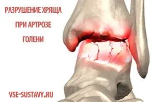 артроз гомілковостопного суглоба лікування симптоми ступеня 1 2 3