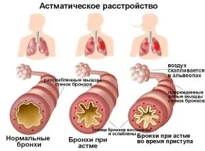 як лікувати бронхіальну астму при вагітності
