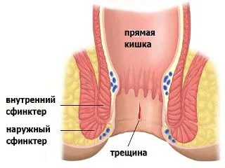 як вилікувати геморой тріщини