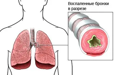 лікувати астму дорослих