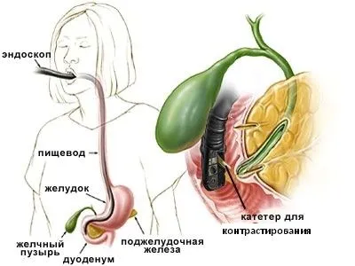 як лікувати лямбліозний холецистит