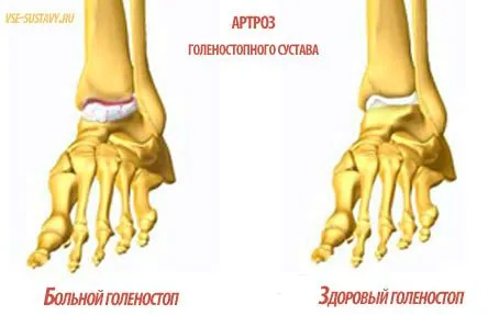 артроз гомілковостопного суглоба лікування симптоми ступеня 1 2 3