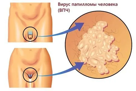 як лікувати аногенітальні бородавки
