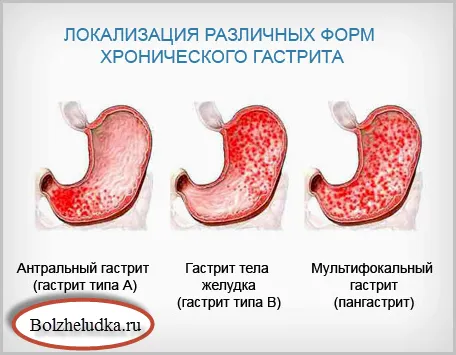ерозивний гастрит