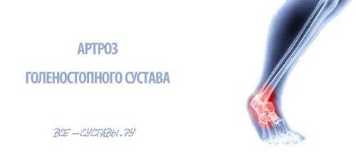 як можна вилікувати артроз гомілковостопного суглоба