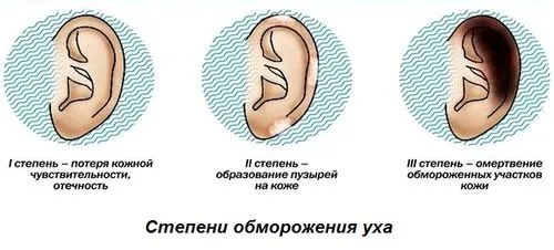 лікувати відморожені вуха