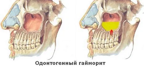 Одонтогенний гайморит - причини, симптоми і лікування одонтогенний гайморит причина симптом ознака лікування
