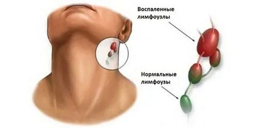 як лікувати кісту шиї