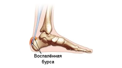 як лікувати бурсит ахілла