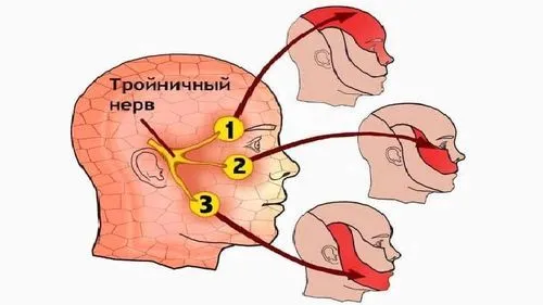 як лікувати невралгію лицьового нерва в домашніх умовах