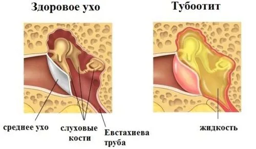 як лікувати тубоотит в домашніх умовах