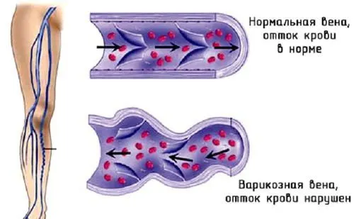 біль у венах на ногах