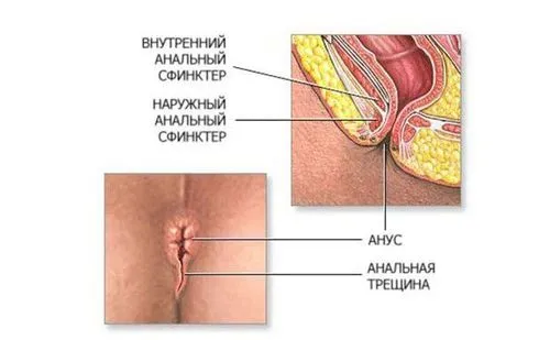 як вилікувати геморой і тріщини