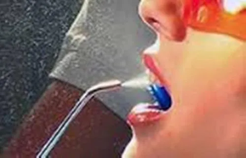 глибокий карієс передніх зубів