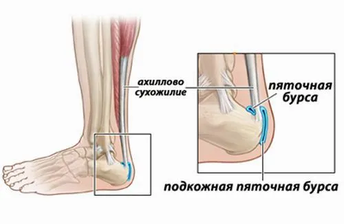 як лікувати бурсит ахілла