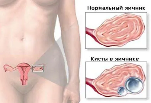 як лікувати ендометріоїдних кісти яєчника