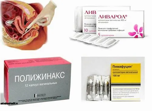 лікування молочниці у жінок
