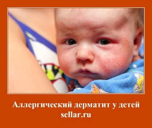 Алергічний дерматит у дітей алергічний дерматит лікування алергічного дерматиту у дітей
