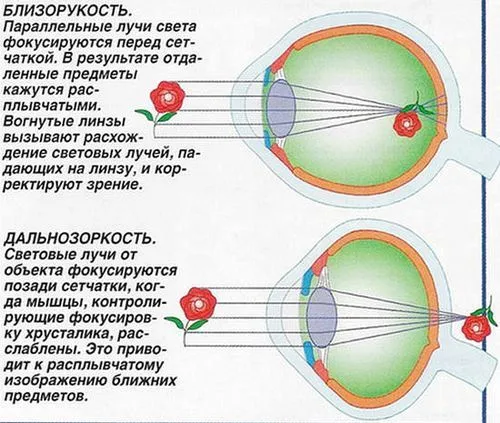 пресбіопія: що це таке і як лікувати