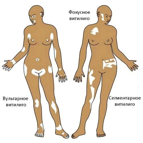 Вітіліго: причини, ознаки, симптоми (фото), лікування лікувати вітіліго домашніх умовах