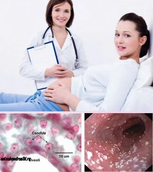 свічки від молочниці