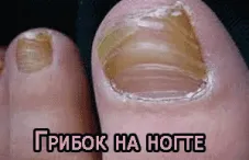 як вилікувати грибок ніг в домашніх умовах