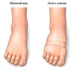 як вилікувати ноги від втоми