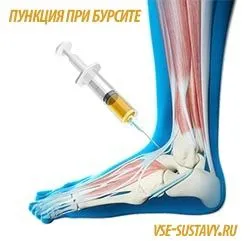 як лікувати бурсит гомілковостопного суглоба