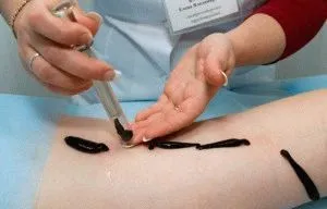 як лікувати розтягнення тазостегнового суглоба