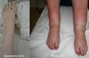як вилікувати ноги від втоми