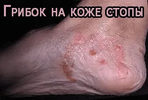 як вилікувати грибок на ногах
