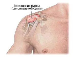 як швидко лікувати бурсит плечового суглоба