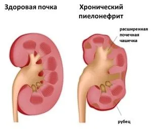 Болять нирки після алкоголю: як лікувати нирки, причини болю болять нирки алкоголь лікувати пиво вплив ранок відновити робити камінь п'янка чистити пієлонефрит вживати людина