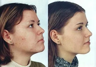 як лікувати демодекс будинку