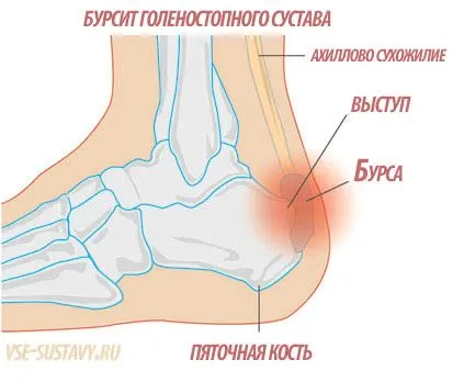 як лікувати бурсит гомілковостопного суглоба