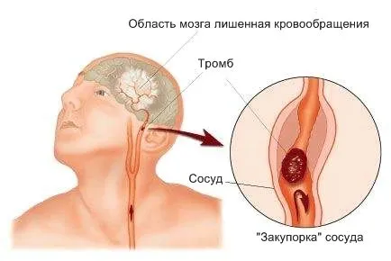 як лікувати наслідки ішемічного інсульту
