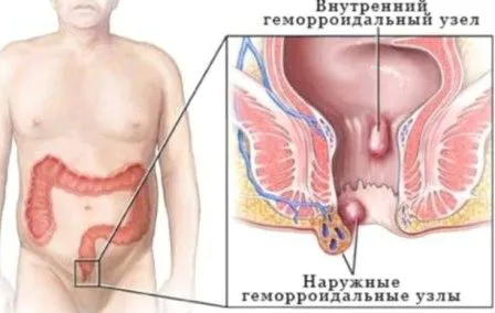 лікувати геморой 1 стадії