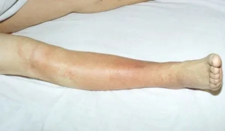 як лікувати рожу