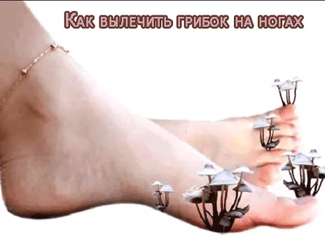 як вилікувати грибок на ногах