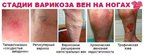 якщо не лікувати варикоз