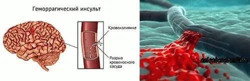 Інсульт: причини і наслідки реабілітація після інсульту