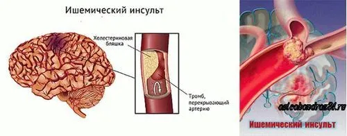 Інсульт: причини і наслідки профілактика інсульту