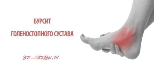 як лікувати бурсит гомілковостопного суглоба