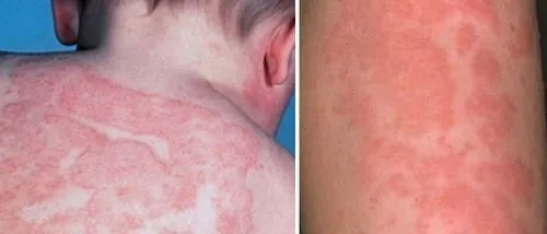 як лікувати дитячу кропивницю
