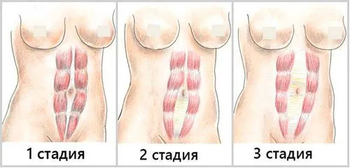 як лікувати розтягнення м'язів живота
