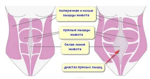 диастаз прямих м'язів живота фото після пологів вправи як визначити лікування