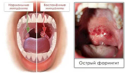 як вилікувати горло і вуха