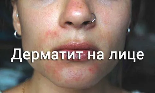 лікувати дерматит