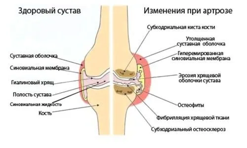як лікувати артроз желатином