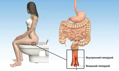 Як вилікувати геморой назавжди? вилікувати геморой назавжди